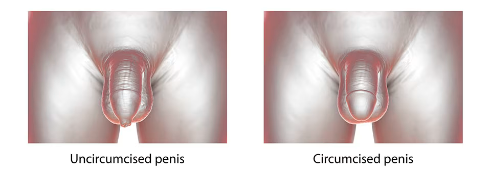 circoncision circoncision